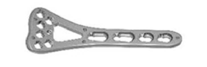 Блокуюча пластина для голівки променевої кістки UMP